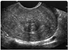 ISTEROSCOPIA DIAGNOSTICA ED OPERATIVA