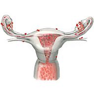 Endometriosi