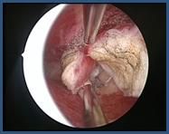 ISTEROSCOPIA DIAGNOSTICA ED OPERATIVA